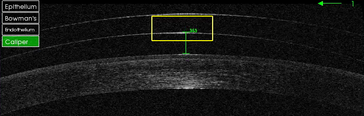 OCT lente escleral sobre cornea con Queratotomia radial