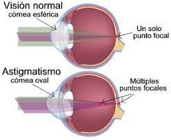 cornea con astigmatismo