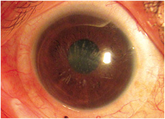 distrofia granular con lente escleral