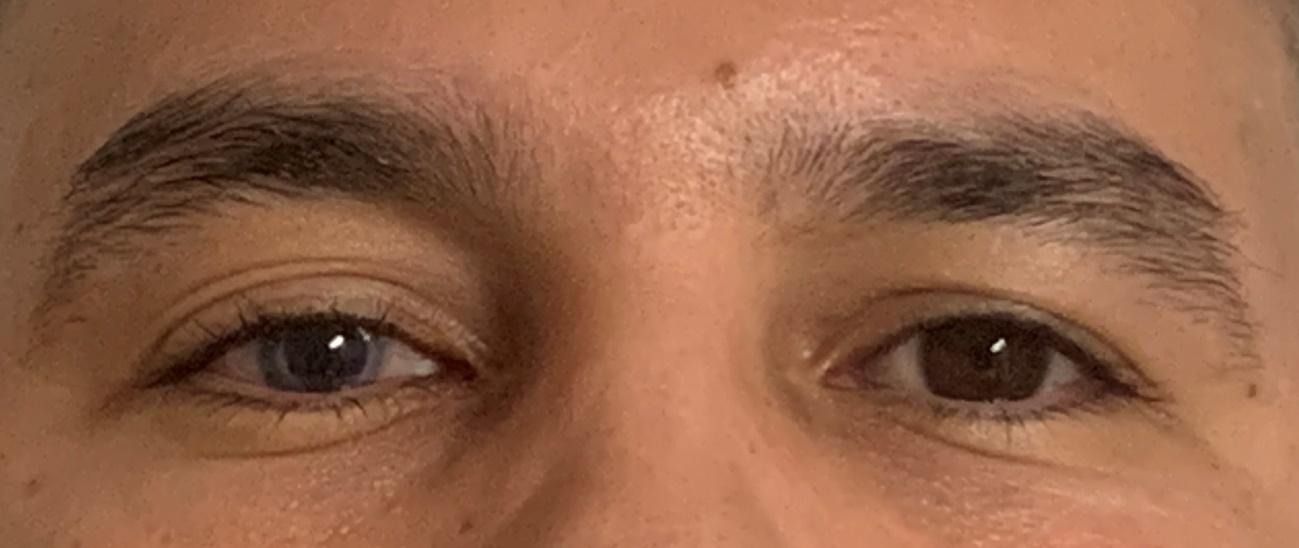 Ojo derecho con atrofia del iris y cambio de coloración tras traumatismo ocular, antes de la adaptación de la lente protésica