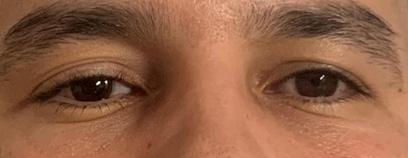 Resultado estético tras la adaptación de lente protésica personalizada con iris pintado y zona central óptica transparente en paciente con traumatismo ocular.