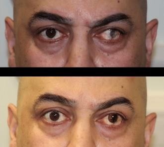 Comparativa antes y después del tratamiento con lente protésica personalizada en paciente con estrabismo; se aprecia el alineamiento estético del eje ocular y la simetría lograda tras la adaptación.