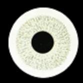 ente protésica personalizada con iris pintado que imita el color y la textura natural del ojo; utilizada en casos de aniridia, coloboma o heterocromía.