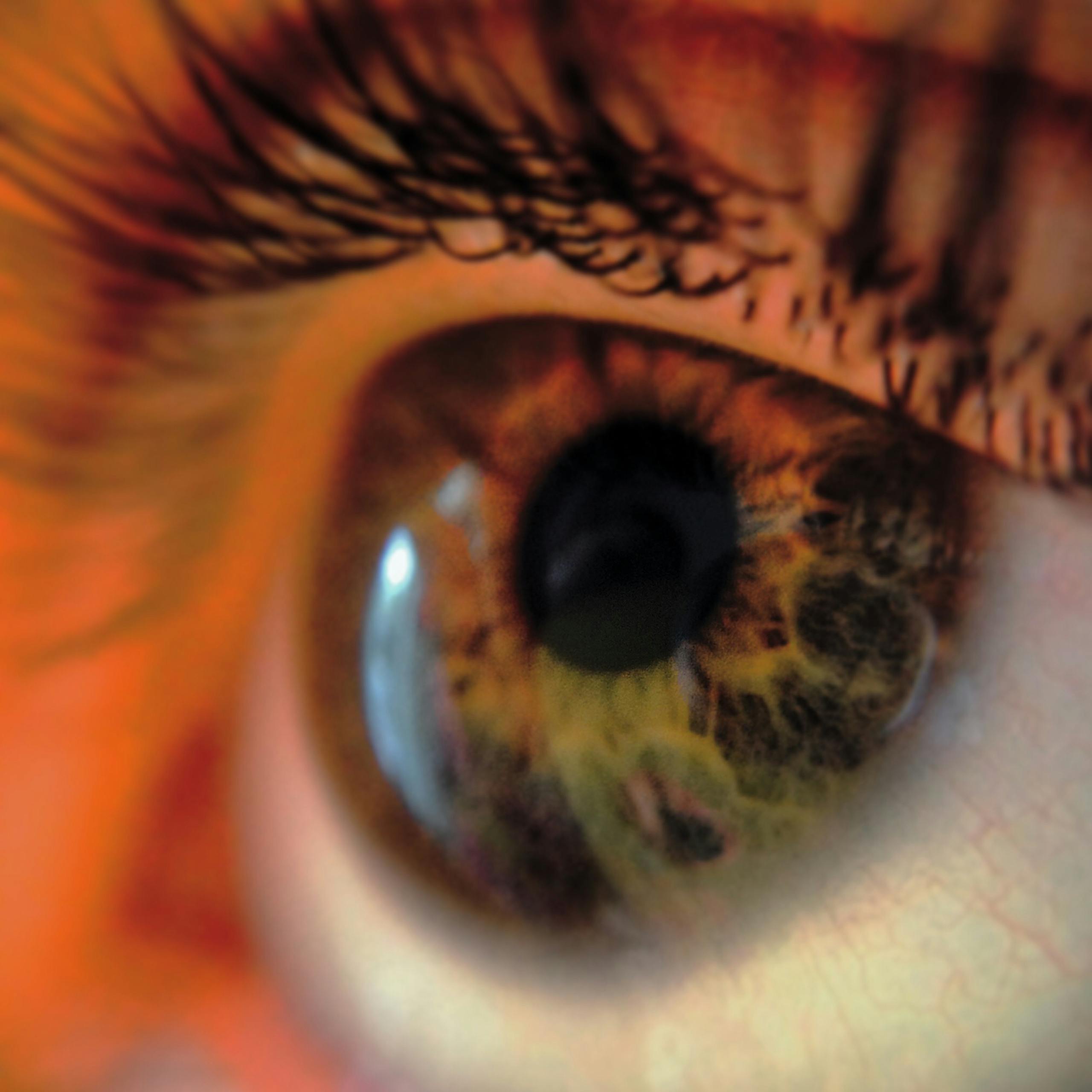 lentillas protésicas