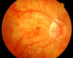 Complicaciones en retina por la miopía