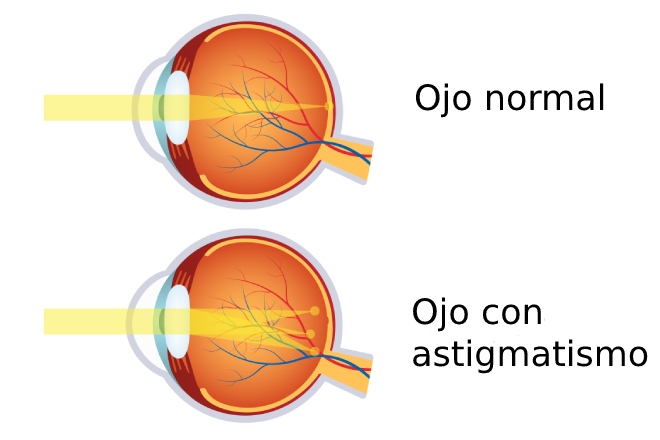 Comparación ojo normal vs ojo con astigmatismo (meridianos curvatura