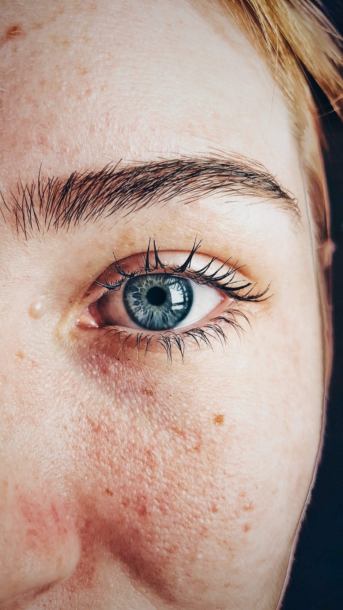 Síndrome de Sjögren: 5 Ventajas de las Lentes Esclerales en el ojo seco