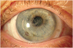 recurrencia de distrofia granular con lente escleral